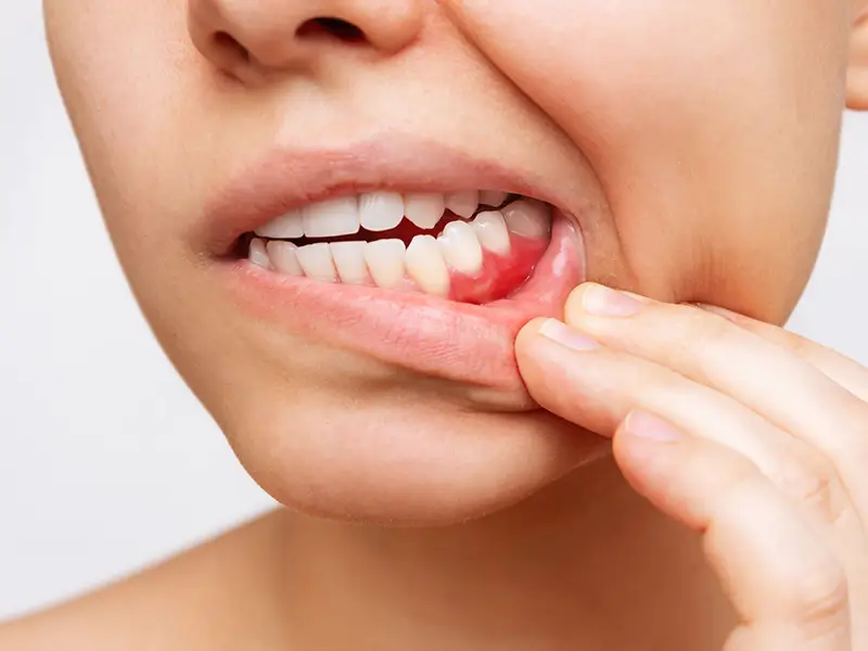 Eine Frau hat eine ausgeprägte Parodontitis.